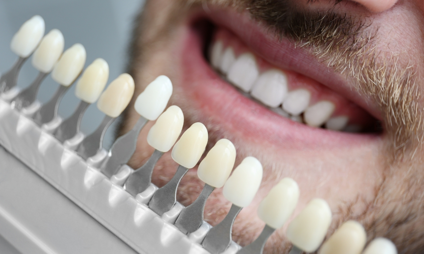 Dental Veneers in Richmond Hill